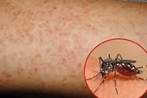 Đồng Nai ghi nhận ca sốt xuất huyết tăng mạnh