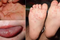 Hà Nội ghi nhận ca mắc bệnh tay chân miệng tăng, 187 ca tại 76 phường xã