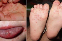 Hà Nội ghi nhận ca mắc bệnh tay chân miệng tăng, 187 ca tại 76 phường xã