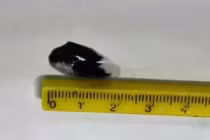 Nội soi phế quản giải cứu 2 ca hóc dị vật đường thở nguy hiểm