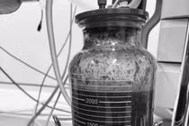 Người phụ nữ bị biến chứng nặng sau 5 năm tiêm chất làm đầy ngực 