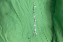 Gắp thành công chiếc vòng tay bạc trong đường tiêu hoá của bé gái 5 tuổi