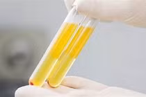 Chữa trị thành công ca viêm tụy cấp do triglycerid cao đột biến