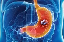 Can thiệp kịp thời cứu bé 6 tuổi ở Phú Thọ xuất huyết tiêu hoá nguy hiểm