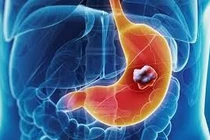 Can thiệp kịp thời cứu bé 6 tuổi ở Phú Thọ xuất huyết tiêu hoá nguy hiểm