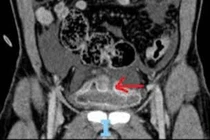 Cứu sống nam bệnh nhân 46 tuổi bị vỡ bàng quang hiếm gặp
