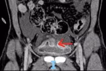 Cứu sống nam bệnh nhân 46 tuổi bị vỡ bàng quang hiếm gặp