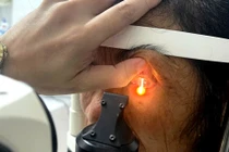 Người phụ nữ suýt hỏng mắt vì dùng hạt na ngâm rượu gội đầu 