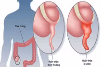 Số ca viêm ruột thừa tăng cuối năm, bác sĩ khuyến cáo đi khám sớm