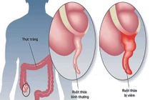 Số ca viêm ruột thừa tăng cuối năm, bác sĩ khuyến cáo đi khám sớm