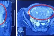 Khối u lớn chiếm gần trọn ổ bụng dưới, khiến người phụ nữ nhầm mang song thai