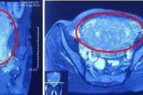 Khối u lớn chiếm gần trọn ổ bụng dưới, khiến người phụ nữ nhầm mang song thai