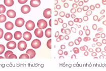 Từ dấu hiệu thiếu máu, phát hiện trẻ mắc bệnh Thalassemia