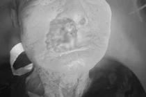 Cụ bà 88 tuổi bị giòi ký sinh trong khối u trên mặt 