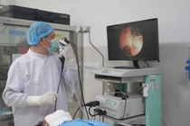 Bệnh viện Đà Nẵng lấy thành công dị vật đường thở tồn tại 20 năm trong phổi