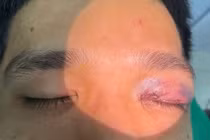 Chấn thương mắt nặng được cứu sống nhờ phẫu thuật kịp thời