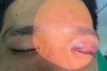 Chấn thương mắt nặng được cứu sống nhờ phẫu thuật kịp thời