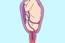 Cứu sống hai mẹ con sản phụ trong thời gian vàng