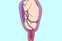 Cứu sống hai mẹ con sản phụ trong thời gian vàng