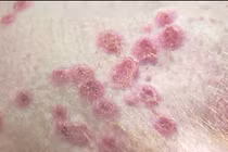 Nam bệnh nhân 33 tuổi dương tính với virus đậu mùa khỉ, chưa rõ nguồn lây