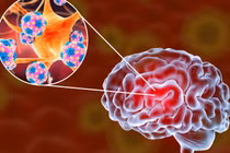 Viêm màng não do nấm Cryptococcus nguy hiểm, cần quan tâm, điều trị sớm 
