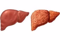 Nam bệnh nhân vỡ giãn tĩnh mạch thực quản được cứu sống như một kỳ tích