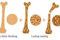 Vì sao nhiều người trẻ mắc bệnh loãng xương?