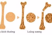 Vì sao nhiều người trẻ mắc bệnh loãng xương?