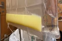 Bệnh nhân viêm tụy cấp nguy hiểm do lạm dụng rượu