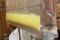 Bệnh nhân viêm tụy cấp nguy hiểm do lạm dụng rượu