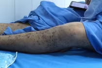 Bệnh nhân thủy đậu biến chứng nặng, thoát chết trong gang tấc