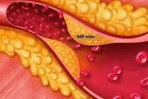 Người phụ nữ có chỉ số mỡ máu cao gấp 37 lần bình thường