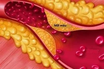 Người phụ nữ có chỉ số mỡ máu cao gấp 37 lần bình thường