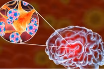 Nguy hiểm của não mô cầu, cách phòng tránh hiệu quả