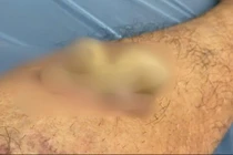 Điều trị u nhú tế bào gai sừng hóa bằng laser tại Đồng Nai