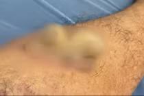 Điều trị u nhú tế bào gai sừng hóa bằng laser tại Đồng Nai