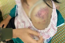 Bé gái 13 tuổi bị bạo hành ở Thái Nguyên, tình hình sức khỏe thế nào?