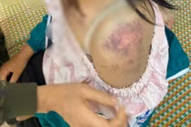 Bé gái 13 tuổi bị bạo hành ở Thái Nguyên, tình hình sức khỏe thế nào?