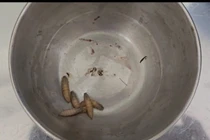 Gắp 5 con giòi sống trong tai một nữ bệnh nhân