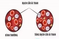 Cứu sống nam bệnh nhân 25 tuổi bị viêm dạ dày – ruột nguy kịch