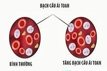 Cứu sống nam bệnh nhân 25 tuổi bị viêm dạ dày – ruột nguy kịch