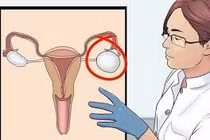 Cắt bỏ khối "u quái" buồng trứng cho bệnh nhân ở Phú Thọ