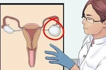 Cắt bỏ khối "u quái" buồng trứng cho bệnh nhân ở Phú Thọ