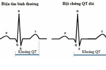 Cứu sống cô gái trẻ ngừng tuần hoàn - hô hấp ngoại viện