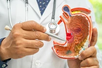 Phát hiện ung thư dạ dày di căn sau khi đi khám đầy bụng khó tiêu