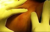 Chữa thành công áp xe cơ thắt lưng cho bé 2 tuổi tại Phú Thọ