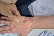 Người đàn ông nhập viện khẩn cấp sau khi bị vây cá đâm