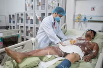 Người đàn ông Campuchia bị bỏng điện cao thế đã qua cơn nguy kịch