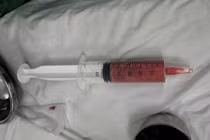 Cô gái 20 tuổi bị áp xe vú nặng sau tiêm filler không rõ nguồn gốc