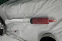 Cô gái 20 tuổi bị áp xe vú nặng sau tiêm filler không rõ nguồn gốc